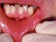 This image displays white-to-yellow lesions typical of apthous ulcers.