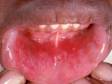 This image displays several small erosions and aphthous ulcers on the lower lip.