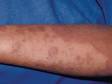 This image displays extensive atopic dermatitis (eczema); note the skin is dry and scaly, which is typical of atopic dermatitis.