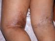 This image displays atopic dermatitis (eczema) in the body folds of the back of the legs coupled with staph bacteria.