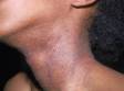 This image displays the typical scaly and slightly pink lesions of atopic dermatitis (eczema) in a teenager.