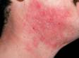 In adults, atopic dermatitis can frequently involve the neck and cheeks.