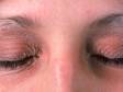 This image displays eyelids that appear thick and scaly, typical to atopic dermatitis (eczema).