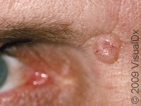 Carcinoma a cellule basali vicino all'occhio
