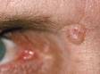 The nodular form of basal cell carcinoma is usually skin-colored with tiny blood vessels visible.