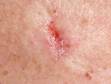 The infiltrating type of basal cell carcinoma can appear as a scar or resemble a superficial skin ulcer. These skin cancers often fool patients because they appear small.