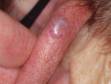This image displays a shiny-appearing lesion with small, visible blood vessels typical of basal cell carcinoma.