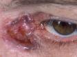 This nodular basal cell carcinoma displays a "rolled" edge, typical to the lesion.
