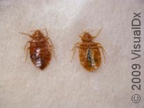 Scabies Bed Bug Bites On Feet