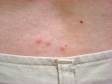 Bedbug bites can often be found in a line or arc on the skin, commonly known as "breakfast, lunch, and dinner."