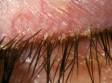 The crusty, grainy, or scaly appearance at the base of the eyelashes is the most common finding in blepharitis.