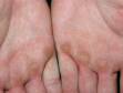 This image displays callouses on the palms from work involving friction to these areas.