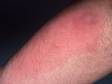 This image displays redness typical in the early stages of cellulitis.