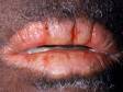 Cheilitis (inflammation of the lips) can cause scaling and severe cracking or fissuring of the lips, as displayed in this image.
