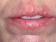 Chapped lips (cheilitis) are lips that are inflamed, scaly, and cracked. Chapped lips may be due to an allergy, irritation, or excessive dryness.