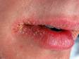 This image displays lips that are inflamed, scaly, and cracked due to cheilitis, which can be due to allergy, irritation, or excessive dryness.