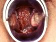 This image displays a woman's cervix with red erosions due to a chlamydial infection.