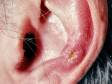 Chondrodermatitis nodularis helicis affects the ear. Sometimes there is a small skin ulcer in the center of the papule, as seen here.