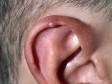 Typical to chondrodermatitis nodularis helicis, there is a very tender, small nodule at the rim of the ear.