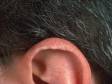 This image displays small elevations of the skin at rim of the ear.