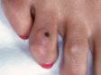 A mole is seen on the fourth toe, next to a callus caused by wearing ill-fitting shoes. Note that the color and border of the mole are regular.