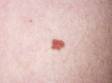 This small reddish-brown, slightly elevated lesion is a benign mole.