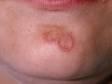 This image displays an unusual "horseshoe-shaped" wart on chin.