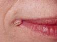 This is a wart at the edge of the lips.