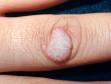 This image displays a wart on a finger.
