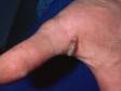 The wart seen in the webspace of the thumb has the rough and thickened appearance typical of common warts.