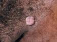 Genital warts (condyloma), can appear anywhere in the genital region.