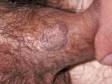 This image displays a large, darkened condyloma (wart) on the shaft of the penis.