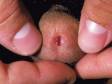 This image displays tiny elevations of the skin at the tip of the penis, typical of genital warts (condylomas).