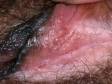 Close-up of condyloma (genital warts) on the labia.