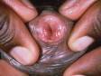 Genital warts (condyloma) can circle the opening of the penis.