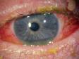 This is the most typical appearance of conjunctivitis with redness of the eye and mucoid debris on the eyelashes.