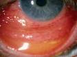 Conjunctivitis makes the surface of the eye red, and it can also make the inner lining of the eyelid red, accompanied by discharge.