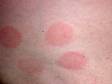Contact dermatitis often has slightly elevated lesions with distinct borders.
