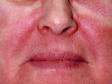 Redness and fine scale can be a sign of an allergic contact dermatitis.