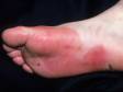 The sharp border of the redness on the foot is due to contact dermatitis from an allergy to a substance in contact with the skin.