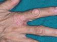 This is irritant contact dermatitis of the web spaces and fingers.