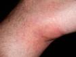 Contact dermatitis that has been present for longer periods of time can appear like many other rashes, with redness, itching and scaling.