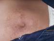 The location of this rash underneath the snap on a pair of denim jeans is a clue that it is caused by nickel/metal allergy.