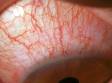 Redness of the eye is the most common finding in contact lens solution toxicity.