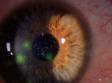 Small corneal abrasions that can't be seen with the naked eye are easily seen with fluorescent dye, which "lights" up the abrasions.