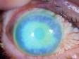 This large corneal abrasion can be seen with the naked eye, but fluorescent dye shows the full extent of involvement.