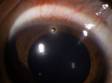 A small corneal foreign body, as displayed here, may not be seen without close inspection.