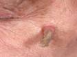 This image displays a cutaneous horn with a red, cancerous skin lesion at the base.