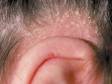 This image displays seborrheic dermatitis on the scalp (dandruff).