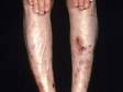 This image displays slow-healing skin lesions and ulcers due to simple trauma typical of diabetic dermopathy.